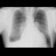 Lung congestion, pleural effusion: X-ray - Plain radiograph